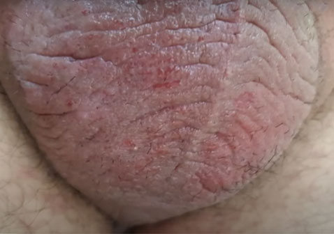 男性阴囊湿疹图片2
