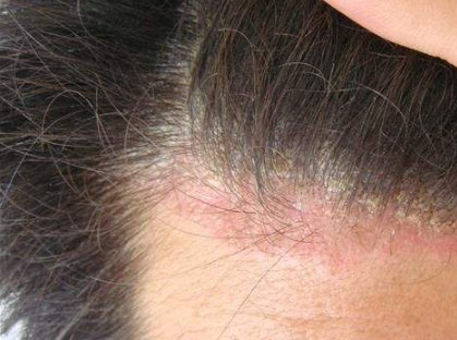 牛皮癣初期症状红色丘疹或斑丘疹图片