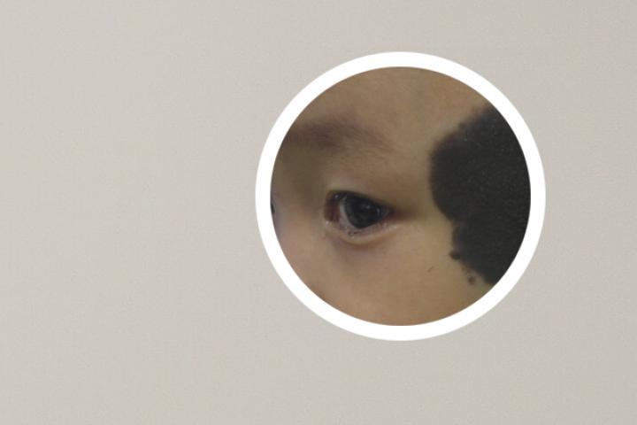 儿童眼角血管瘤图片