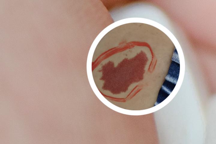 红胎记和鲜红斑痣的区别-斑痣和胎记有区别吗
