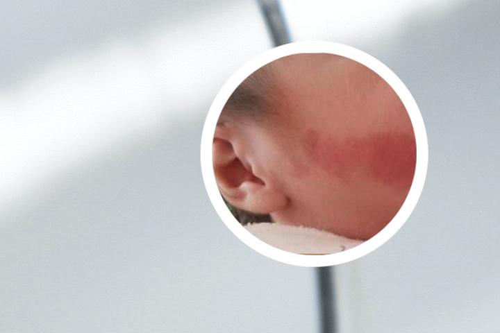 婴儿鲜红斑痣症状表现