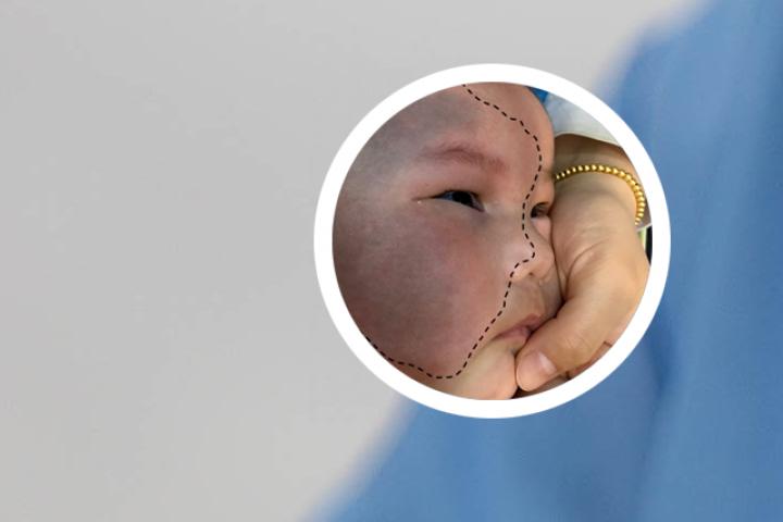 新生儿脸上有青色胎记能治好吗