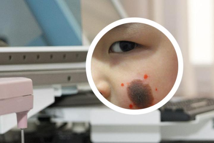 新生儿红斑和鲜红斑痣的区别图片