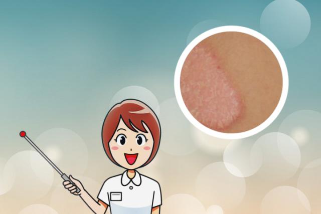 皮肤癣和湿疹的区别