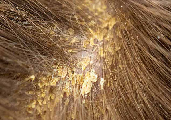 头皮屑大块能扣下来用什么洗发水和治疗药物