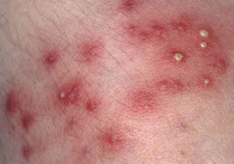 阴囊湿疹病毒感染图片图片