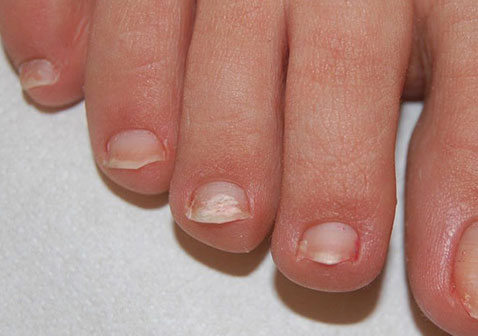 最轻微的灰指甲和白色浅表灰指甲的初期症状迹象图片