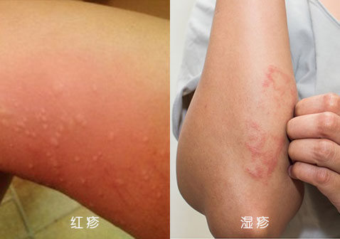 皮疹红疹和湿疹的区别对比图片
