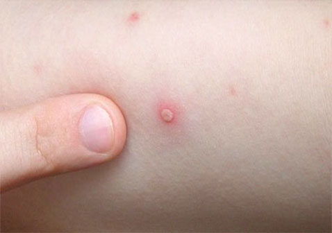 水痘早期症状图