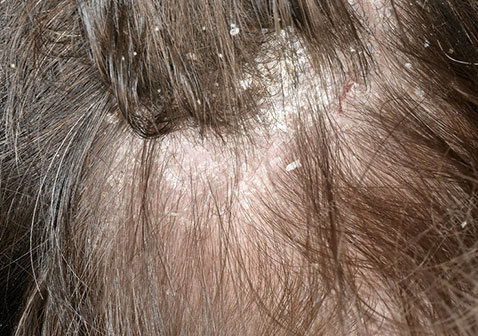 头皮上有大块头皮屑还有结痂症状图片及原因怎么治