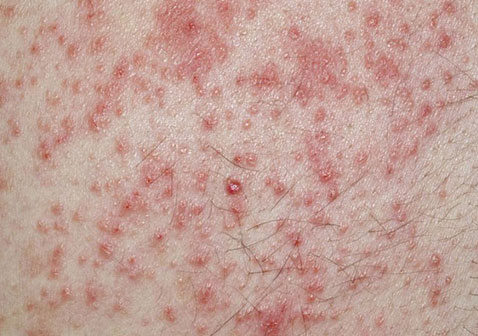 湿疹和痱子症状图片图片