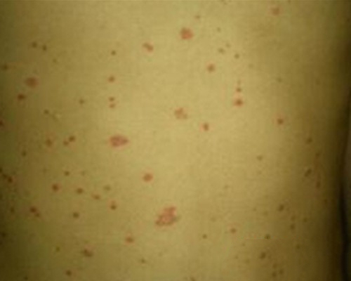 脂溢性皮炎和银屑病的区别图片