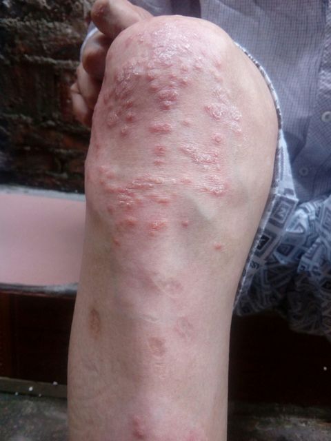 湿疹是传染病吗图片