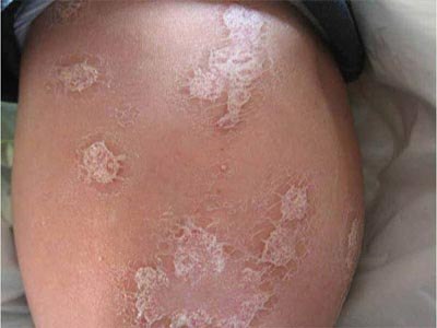 脂溢性皮炎是什么症状图片