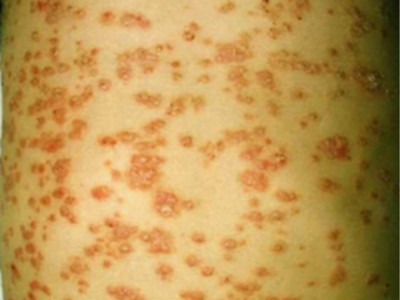 湿疹分为哪几种及图片