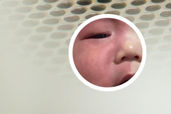 新生儿眼皮血管瘤图片
